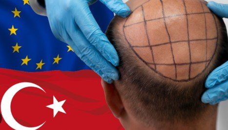 Best hair transplant clinics in Turkey